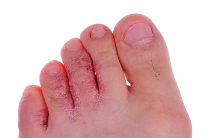 Gljivice na noktima i neugodni mirisi nogu