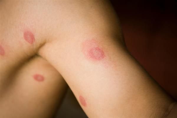Gljivične infekcije na koži